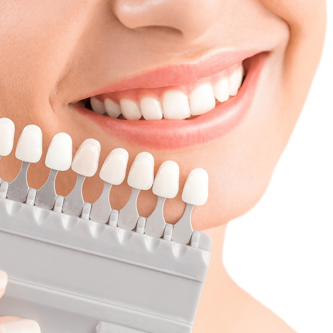 Atelier do Sorriso - Clareamento-min